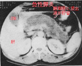 消化器疾患 膵炎 膵癌 Nash 体質性黄疸 ウイルス肝炎