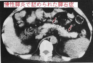 消化器疾患 膵炎 膵癌 Nash 体質性黄疸 ウイルス肝炎